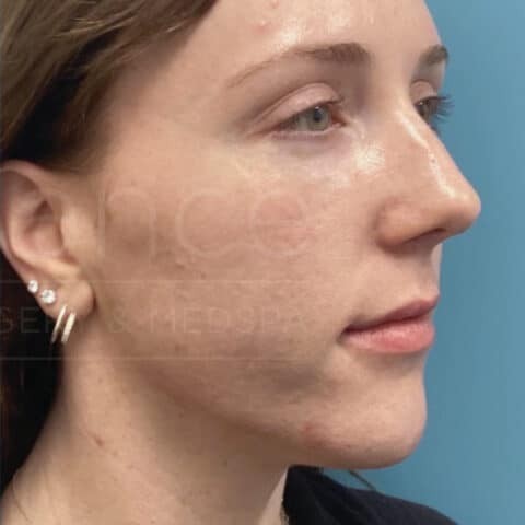 Chin Implants before and after - after