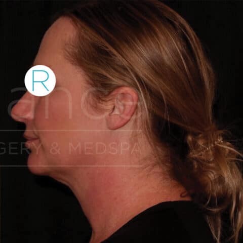 Liposuction before and after - after