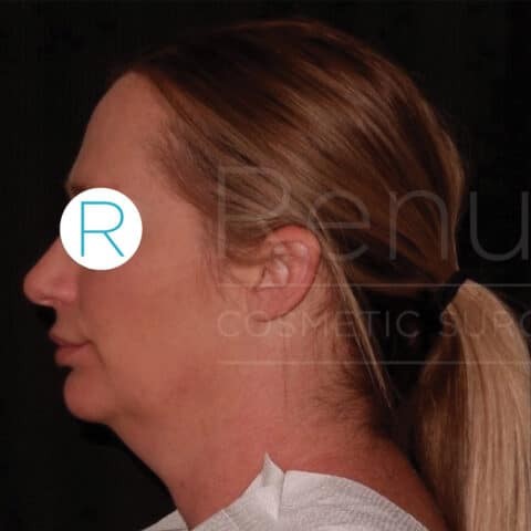 Liposuction before and after - before