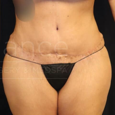 Liposuction before and after - after