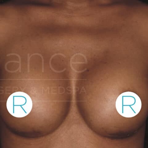 Breast Augmentation before and after - after