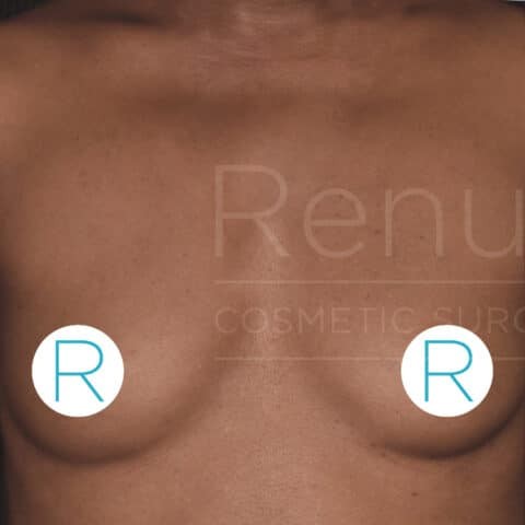 Breast Augmentation before and after - before