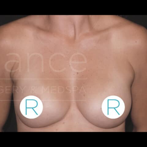 Breast Augmentation before and after - after