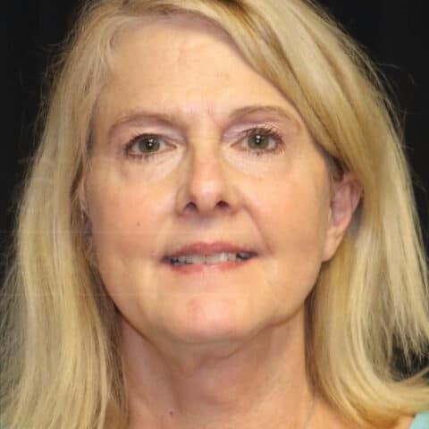 Facelift before and after - after