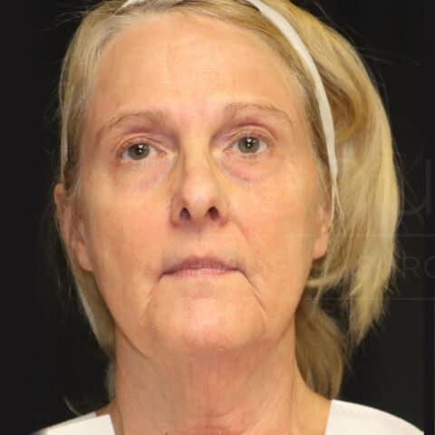 Facelift before and after - before