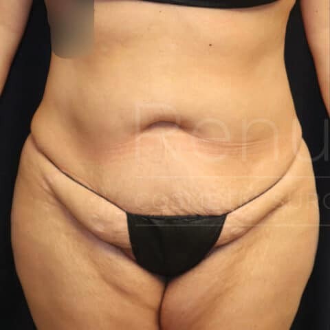 Facelift before and after - before