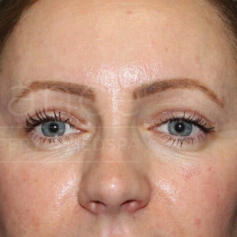 Blepharoplasty before and after - after