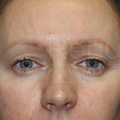 Blepharoplasty before and after - before