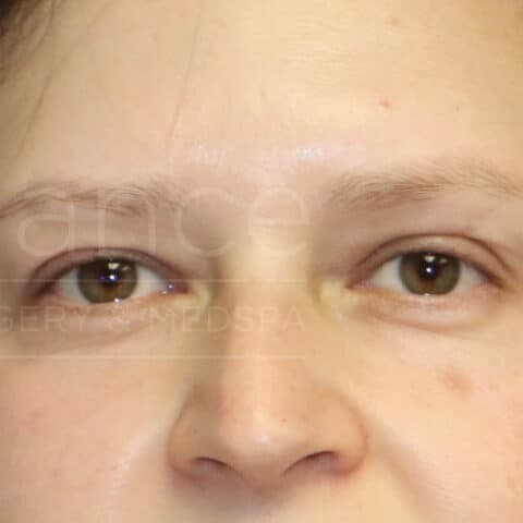 Blepharoplasty before and after - after
