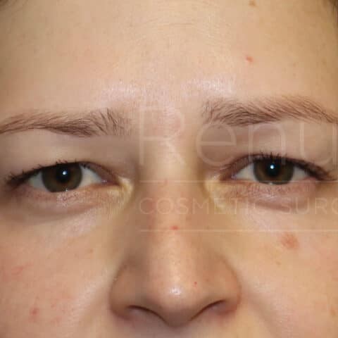 Blepharoplasty before and after - before