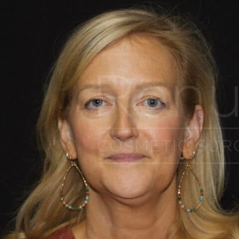 Facelift before and after - before