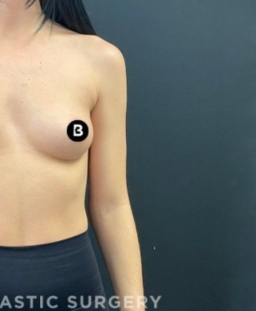 Procedure before and after - after