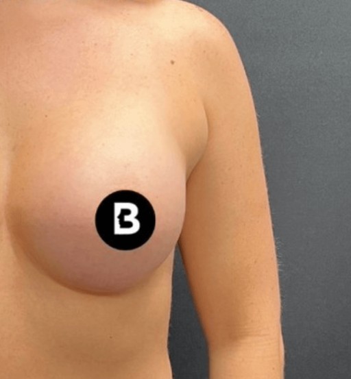 Procedure before and after - after