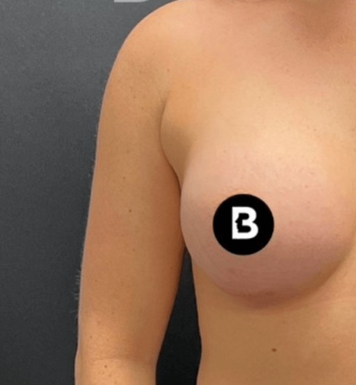 Procedure before and after - before