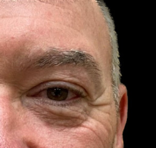 Blepharoplasty before and after - after