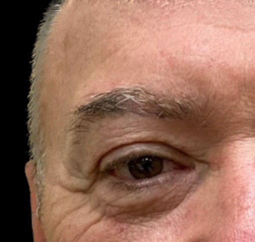 Blepharoplasty before and after - before