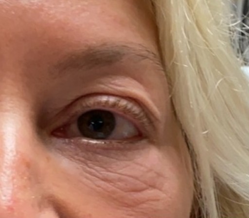 Blepharoplasty before and after - after