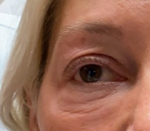 Blepharoplasty before and after - before