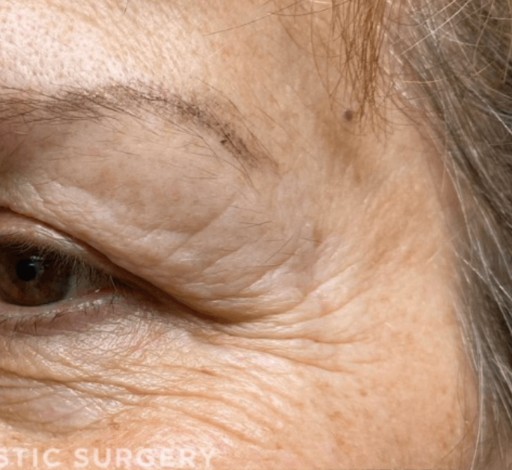 Blepharoplasty before and after - after