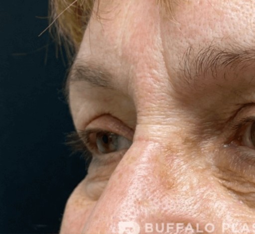 Blepharoplasty before and after - before