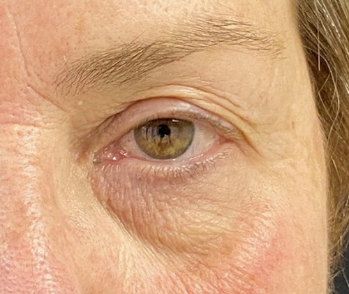 Blepharoplasty before and after - after