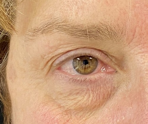 Blepharoplasty before and after - before