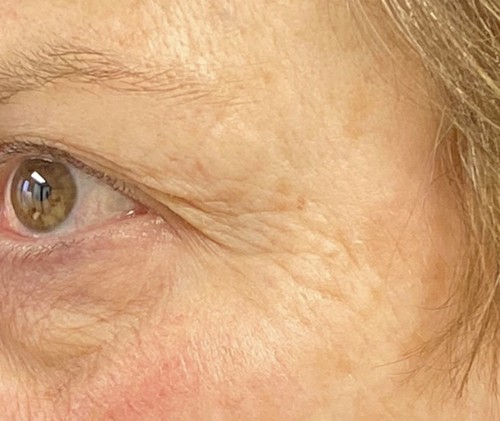 Blepharoplasty before and after - after
