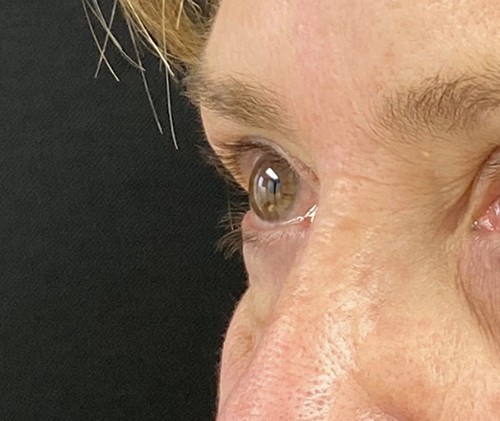 Blepharoplasty before and after - before