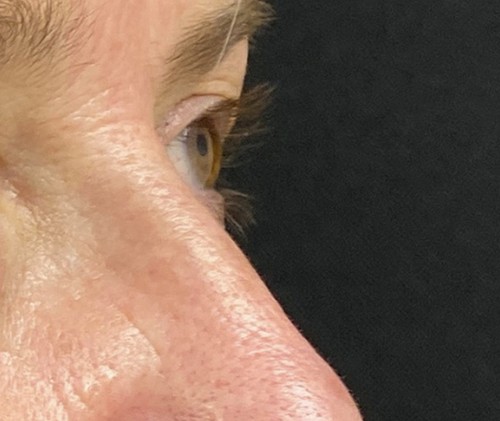 Blepharoplasty before and after - after