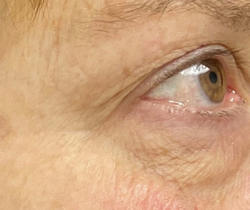 Blepharoplasty before and after - before