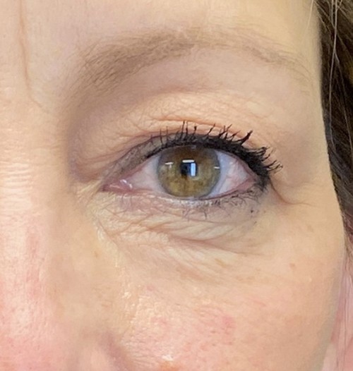 Blepharoplasty before and after - after