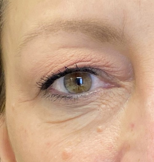 Blepharoplasty before and after - before