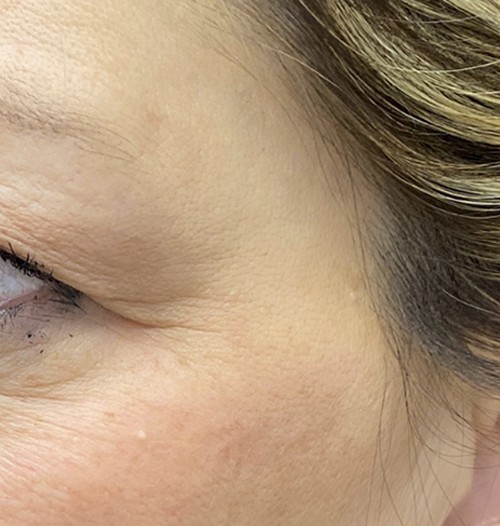 Blepharoplasty before and after - after