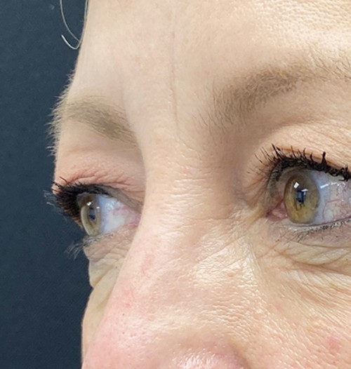 Blepharoplasty before and after - before