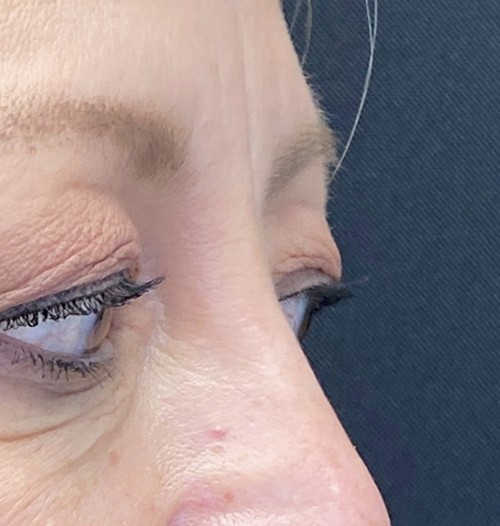 Blepharoplasty before and after - after
