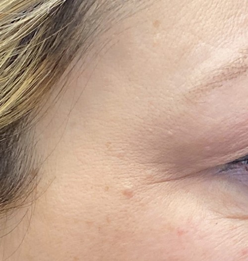 Blepharoplasty before and after - before