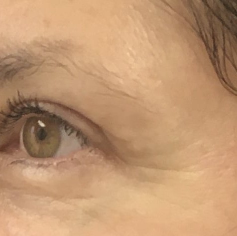Blepharoplasty before and after - after