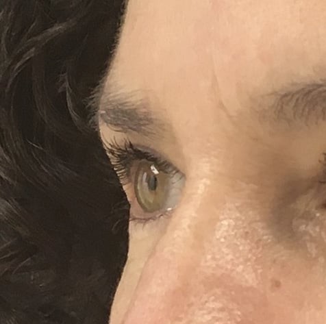 Blepharoplasty before and after - before