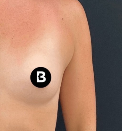 Procedure before and after - after
