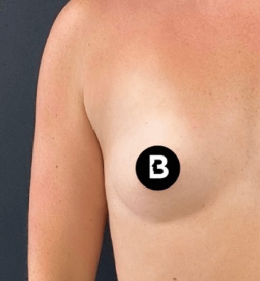 Procedure before and after - before