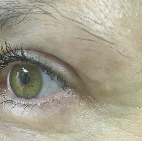 Blepharoplasty before and after - after