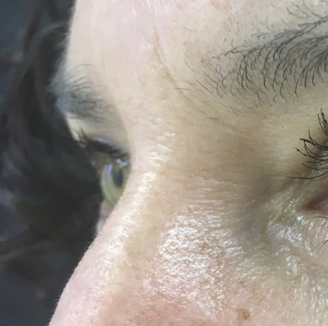Blepharoplasty before and after - before