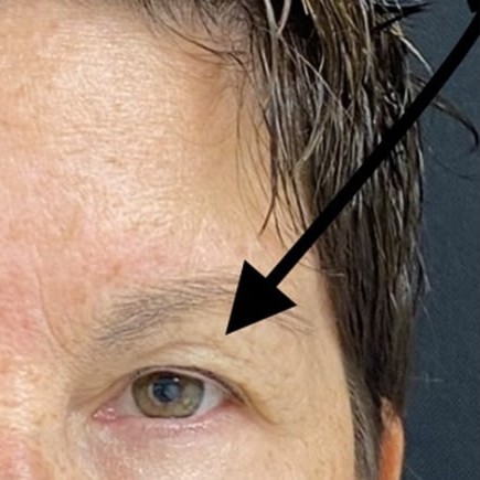 Blepharoplasty before and after - after
