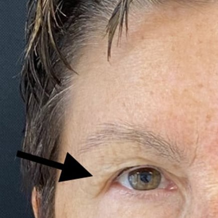 Blepharoplasty before and after - before