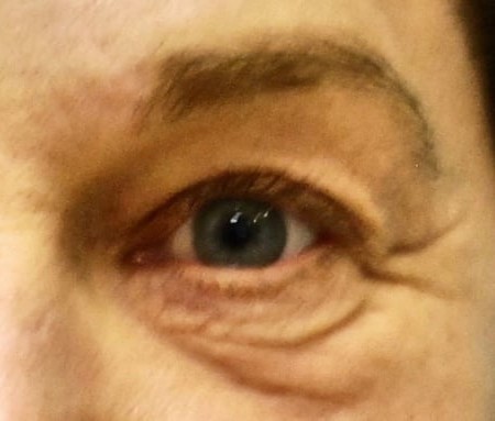 Blepharoplasty before and after - after