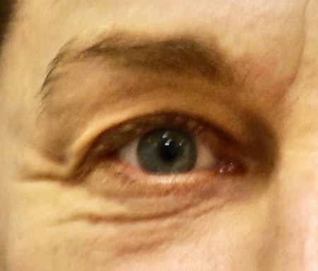 Blepharoplasty before and after - before