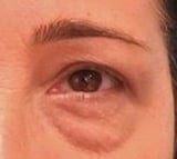 Blepharoplasty before and after - after