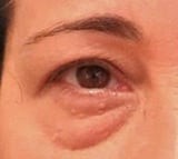 Blepharoplasty before and after - before