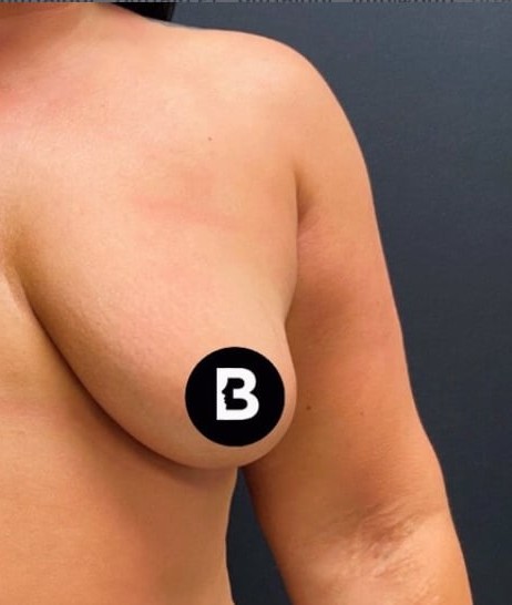 Procedure before and after - after