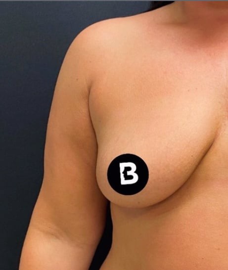 Procedure before and after - before